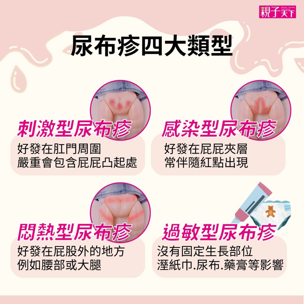 尿布疹四大類型-刺激型,感染型,悶熱型,過敏型