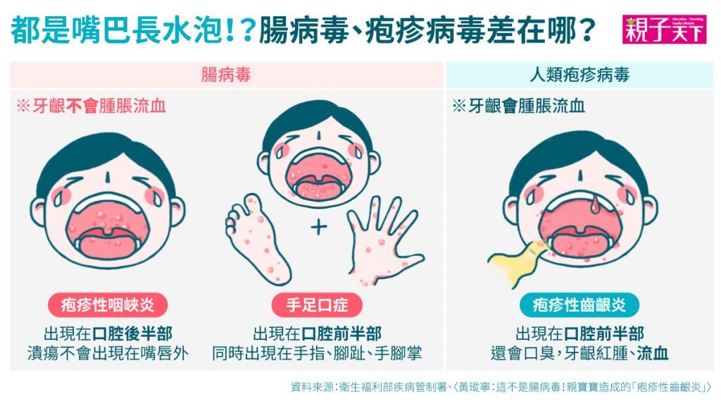 腸病毒、疱疹病毒差在哪？