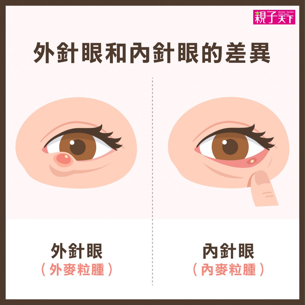 針眼-內針眼-外針眼-針眼會自己好嗎-針眼症狀