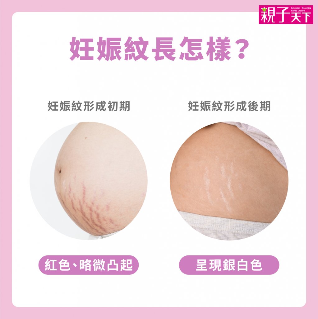 妊娠紋-妊娠紋長怎樣