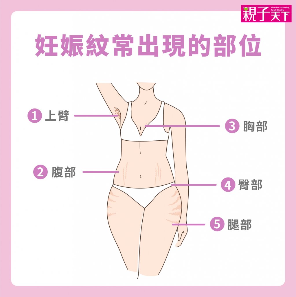 妊娠紋長在哪-妊娠紋