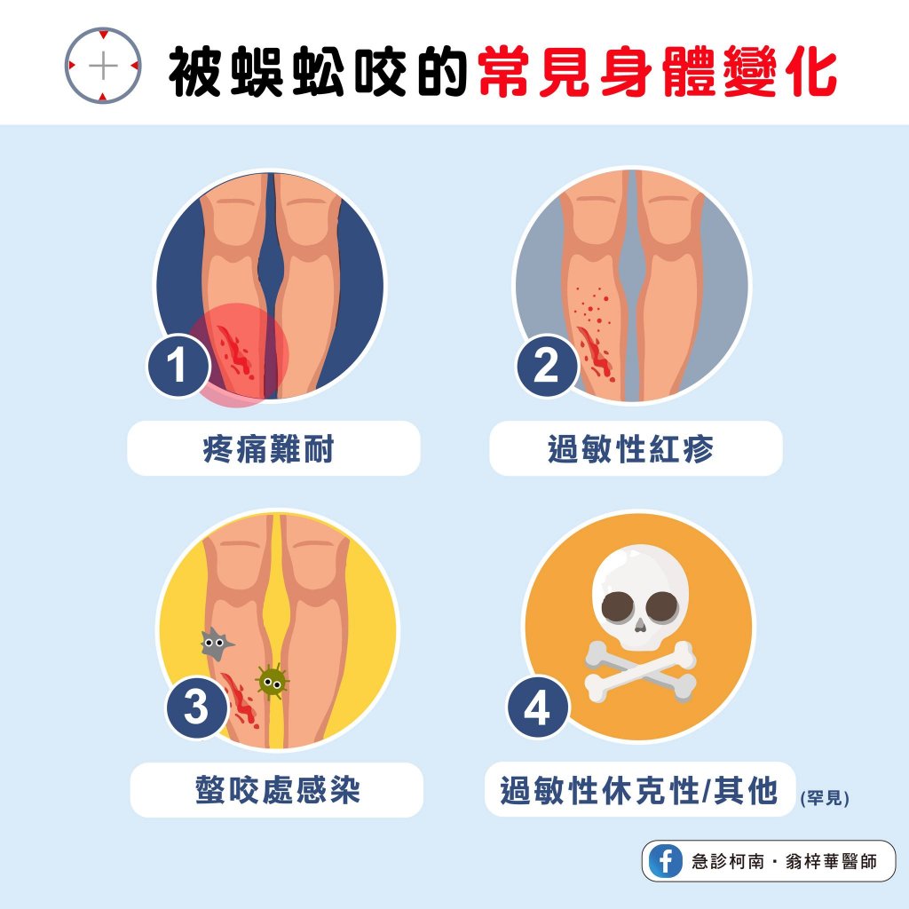 被蜈蚣咬到可能症狀