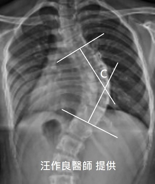 側彎角度