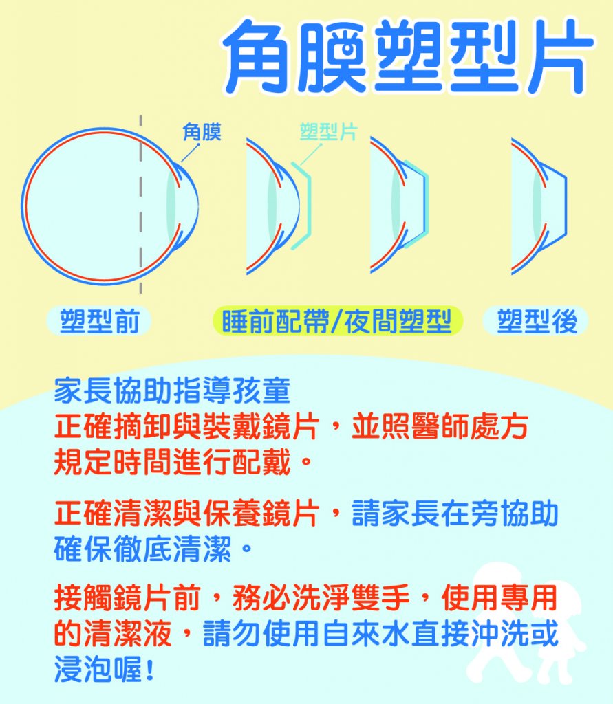 角膜塑型片-角膜塑型片價格-角膜塑型片後遺症-角膜塑型片多久換一次